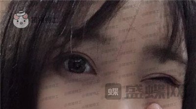 长沙亚韩郑京湘双眼皮案例价格分享,忘记自己做过双眼皮像是自己天生的。