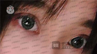 长沙亚韩郑京湘双眼皮案例价格分享,忘记自己做过双眼皮像是自己天生的。
