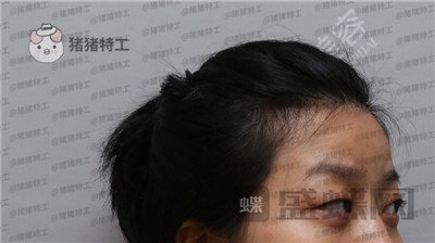 武汉美基元双眼皮案例价格分享,我的眼睛本来就很大割了更大了!