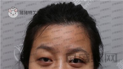 武汉美基元双眼皮案例价格分享,我的眼睛本来就很大割了更大了!
