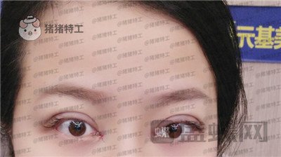 武汉美基元双眼皮案例价格分享,我的眼睛本来就很大割了更大了!