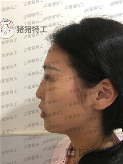 温州伯思立倪锋面部填充案例价格分享,说我现在十八岁没人不信吧!