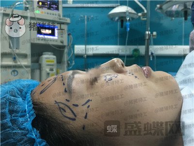 温州伯思立倪锋面部填充案例价格分享,说我现在十八岁没人不信吧!