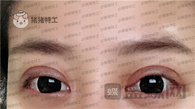 武汉美基元双眼皮案例价格分享,我的眼睛本来就很大割了更大了!