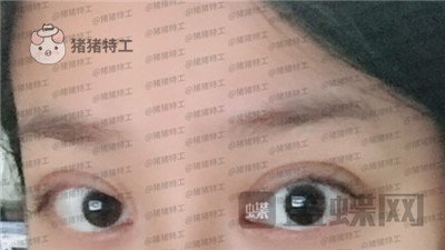 武汉美基元双眼皮案例价格分享,我的眼睛本来就很大割了更大了!