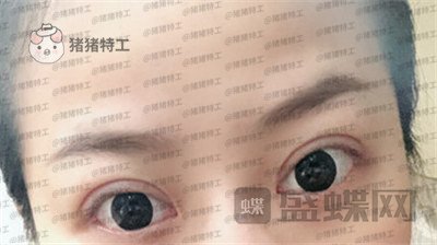 武汉美基元双眼皮案例价格分享,我的眼睛本来就很大割了更大了!
