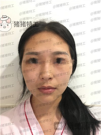 温州伯思立倪锋面部填充案例价格分享,说我现在十八岁没人不信吧!
