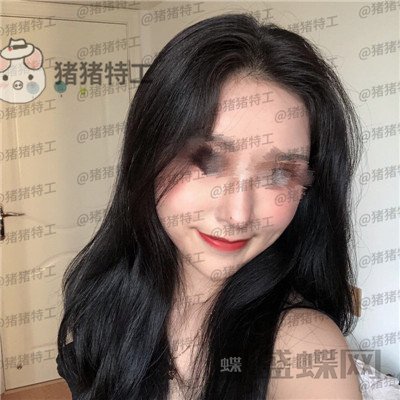温州伯思立倪锋面部填充案例价格分享,说我现在十八岁没人不信吧!