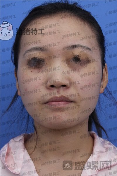 苏州美莱吴蓉鼻部手术案例价格分享,隆鼻一时爽一直美丽一直爽~