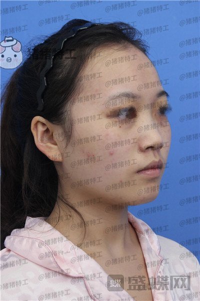 苏州美莱吴蓉鼻部手术案例价格分享,隆鼻一时爽一直美丽一直爽~
