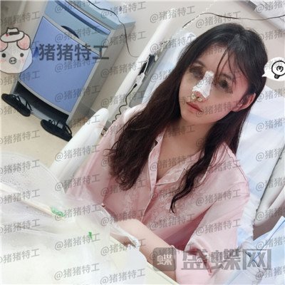 苏州美莱吴蓉鼻部手术案例价格分享,隆鼻一时爽一直美丽一直爽~