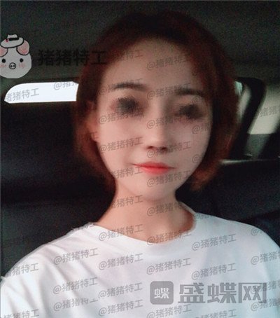 苏州美莱吴蓉鼻部手术案例价格分享,隆鼻一时爽一直美丽一直爽~