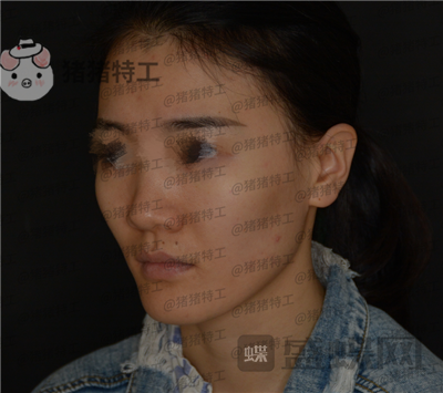 成都天使之翼尤军面部填充案例价格分享,这果完全和之前判若两人哦~