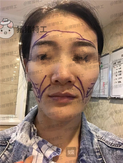 成都天使之翼尤军面部填充案例价格分享,这果完全和之前判若两人哦~