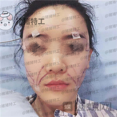 成都天使之翼尤军面部填充案例价格分享,这果完全和之前判若两人哦~