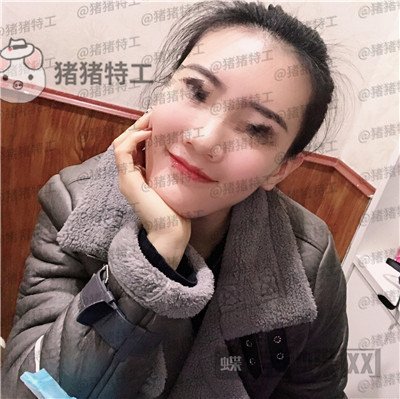 成都天使之翼尤军面部填充案例价格分享,这果完全和之前判若两人哦~