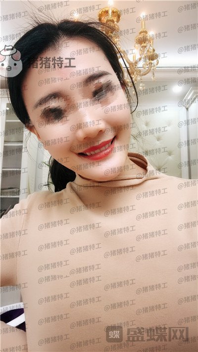 成都天使之翼尤军面部填充案例价格分享,这果完全和之前判若两人哦~