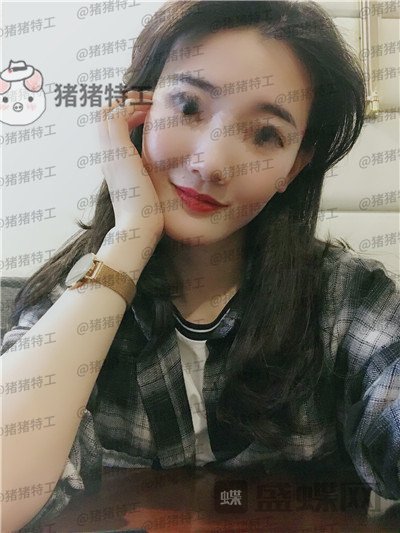 成都天使之翼尤军面部填充案例价格分享,这果完全和之前判若两人哦~