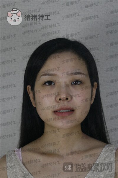 四川友谊张立天颧骨整形案例价格分享,颧骨一改整个人青春洋溢~