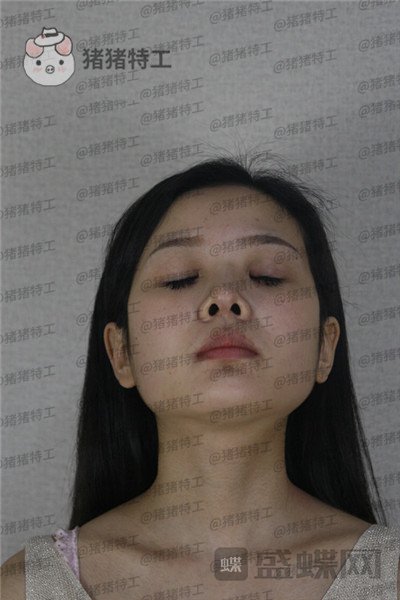 四川友谊张立天颧骨整形案例价格分享,颧骨一改整个人青春洋溢~