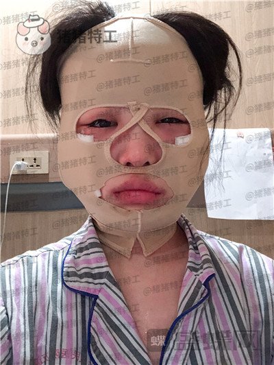 四川友谊张立天颧骨整形案例价格分享,颧骨一改整个人青春洋溢~