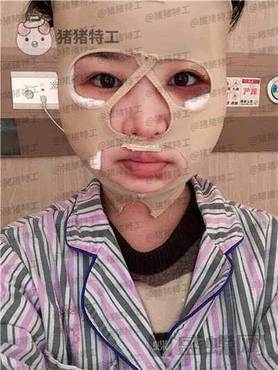 四川友谊张立天颧骨整形案例价格分享,颧骨一改整个人青春洋溢~