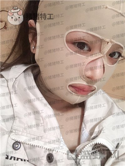 四川友谊张立天颧骨整形案例价格分享,颧骨一改整个人青春洋溢~