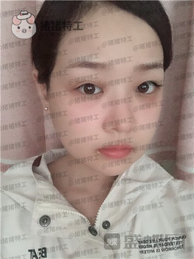 四川友谊张立天颧骨整形案例价格分享,颧骨一改整个人青春洋溢~