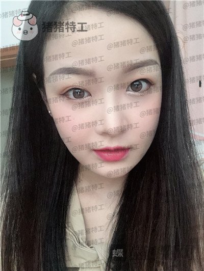 四川友谊张立天颧骨整形案例价格分享,颧骨一改整个人青春洋溢~