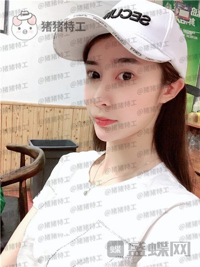 杭州维多利亚刘中策鼻部手术案例价格分享,高挺的鼻子给人气质加了很多分~