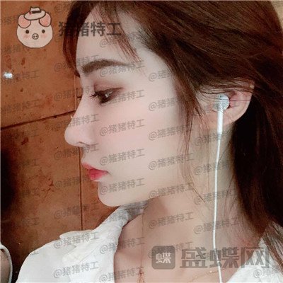 杭州维多利亚刘中策鼻部手术案例价格分享,高挺的鼻子给人气质加了很多分~
