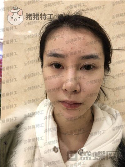 杭州维多利亚刘中策鼻部手术案例价格分享,高挺的鼻子给人气质加了很多分~