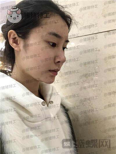 杭州维多利亚刘中策鼻部手术案例价格分享,高挺的鼻子给人气质加了很多分~