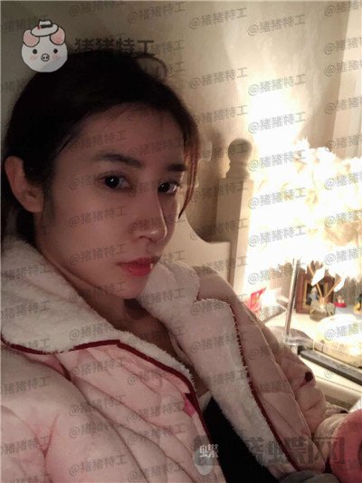 杭州维多利亚刘中策鼻部手术案例价格分享,高挺的鼻子给人气质加了很多分~
