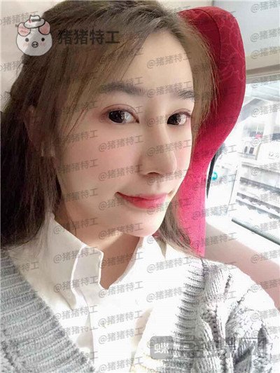 杭州维多利亚刘中策鼻部手术案例价格分享,高挺的鼻子给人气质加了很多分~