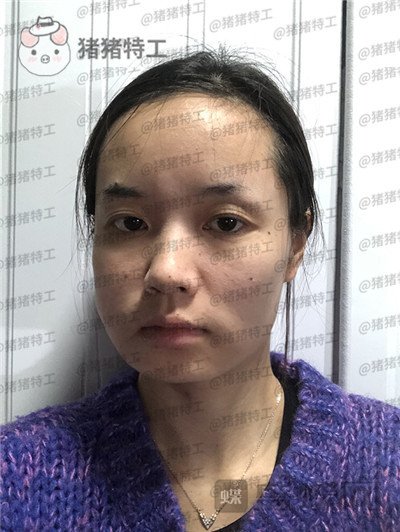 重庆万家燕王珍祥下颌角整形案例价格分享,国字脸的救星来了!