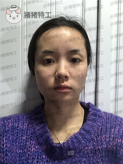 重庆万家燕王珍祥下颌角整形案例价格分享,国字脸的救星来了!