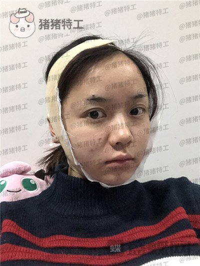 重庆万家燕王珍祥下颌角整形案例价格分享,国字脸的救星来了!