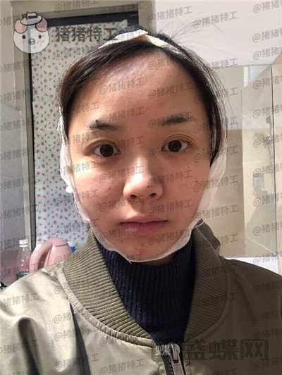 重庆万家燕王珍祥下颌角整形案例价格分享,国字脸的救星来了!