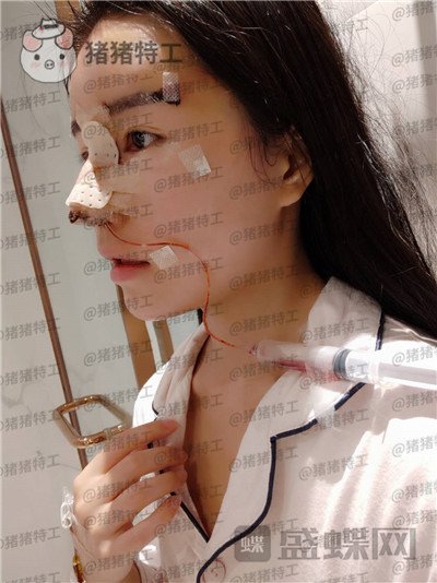 成都格莱丽王伟隆鼻案例价格分享,没发现高级脸较需要的就是完美的鼻子吗?