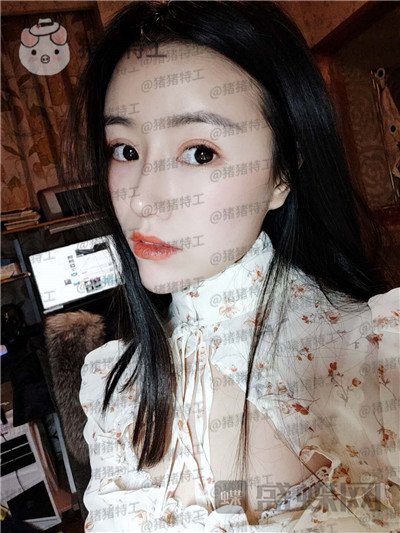成都格莱丽王伟隆鼻案例价格分享,没发现高级脸较需要的就是完美的鼻子吗?