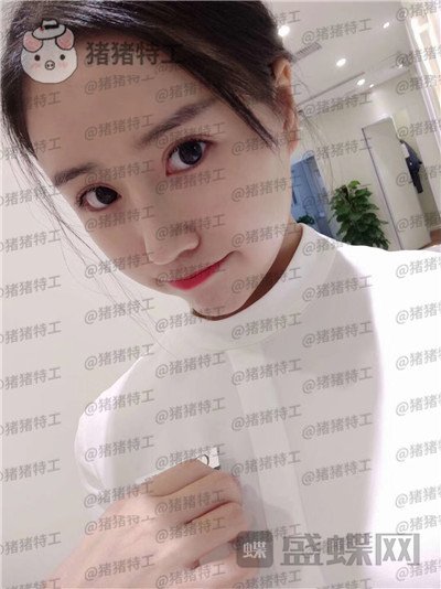 成都格莱丽王伟隆鼻案例价格分享,没发现高级脸较需要的就是完美的鼻子吗?