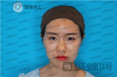 成都格莱丽王伟隆鼻案例价格分享,没发现高级脸较需要的就是完美的鼻子吗?