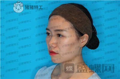 成都格莱丽王伟隆鼻案例价格分享,没发现高级脸较需要的就是完美的鼻子吗?