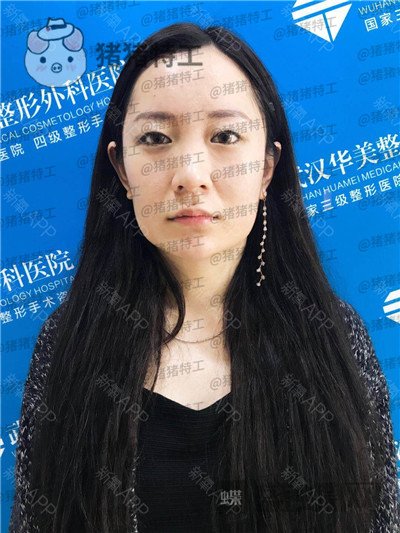 武汉华美马行鼻部手术案例价格分享,一个好看的鼻子有多重要看了就知道!
