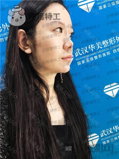 武汉华美马行鼻部手术案例价格分享,一个好看的鼻子有多重要看了就知道!