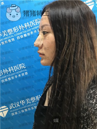 武汉华美马行鼻部手术案例价格分享,一个好看的鼻子有多重要看了就知道!