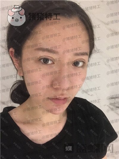 武汉华美马行鼻部手术案例价格分享,一个好看的鼻子有多重要看了就知道!