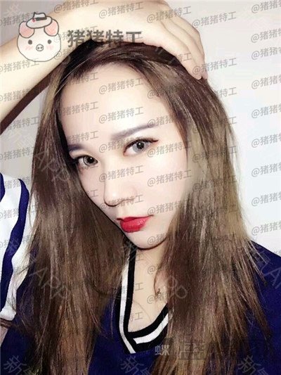 武汉华美马行鼻部手术案例价格分享,一个好看的鼻子有多重要看了就知道!