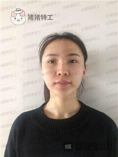上海愉悦美联臣荣峥鼻部手术案例价格分享,让我嫌弃的鼻子终于给我自信了!